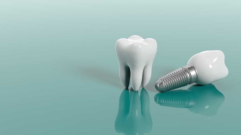 4 motivos para fazer um implante dentário em 2023
