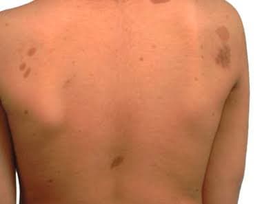 Doença rara: NeurofibromatoseF1 pode afetar a pele e o sistema neurológico