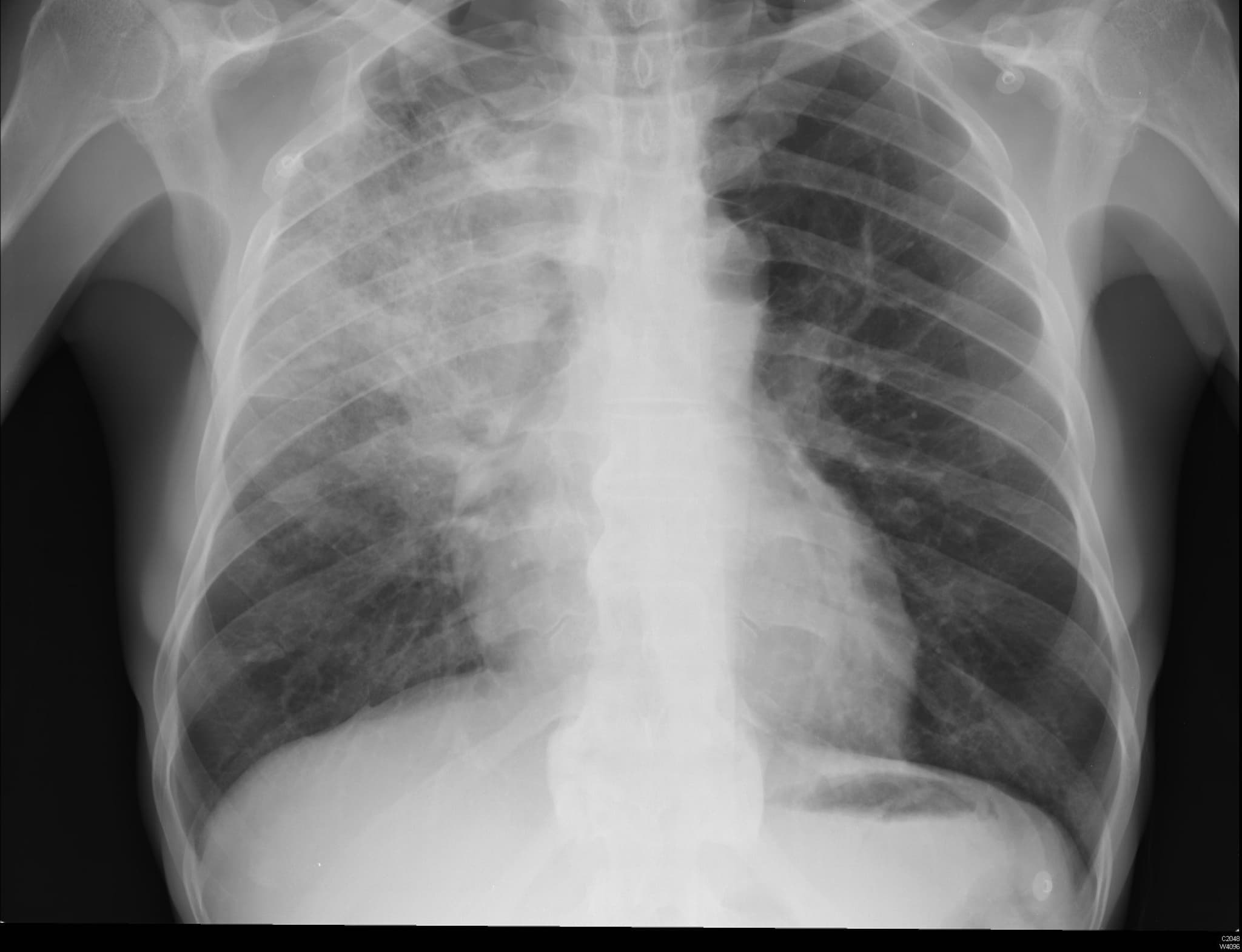Existe 4 tipos de pneumonia – veja quais são as suas diferenças