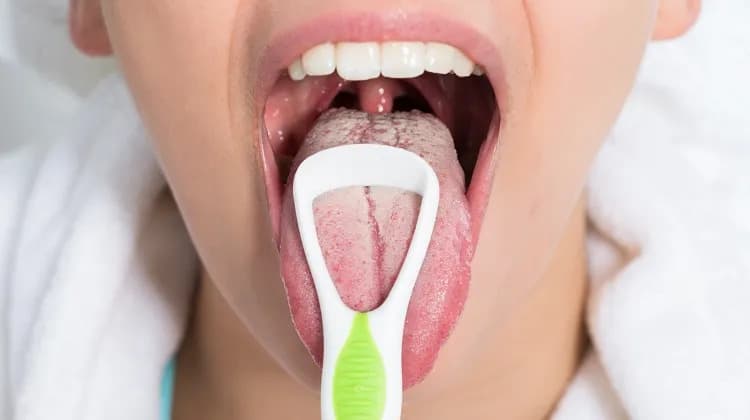 A importância da higiene bucal: alerta sobre as doenças que podem causar língua branca